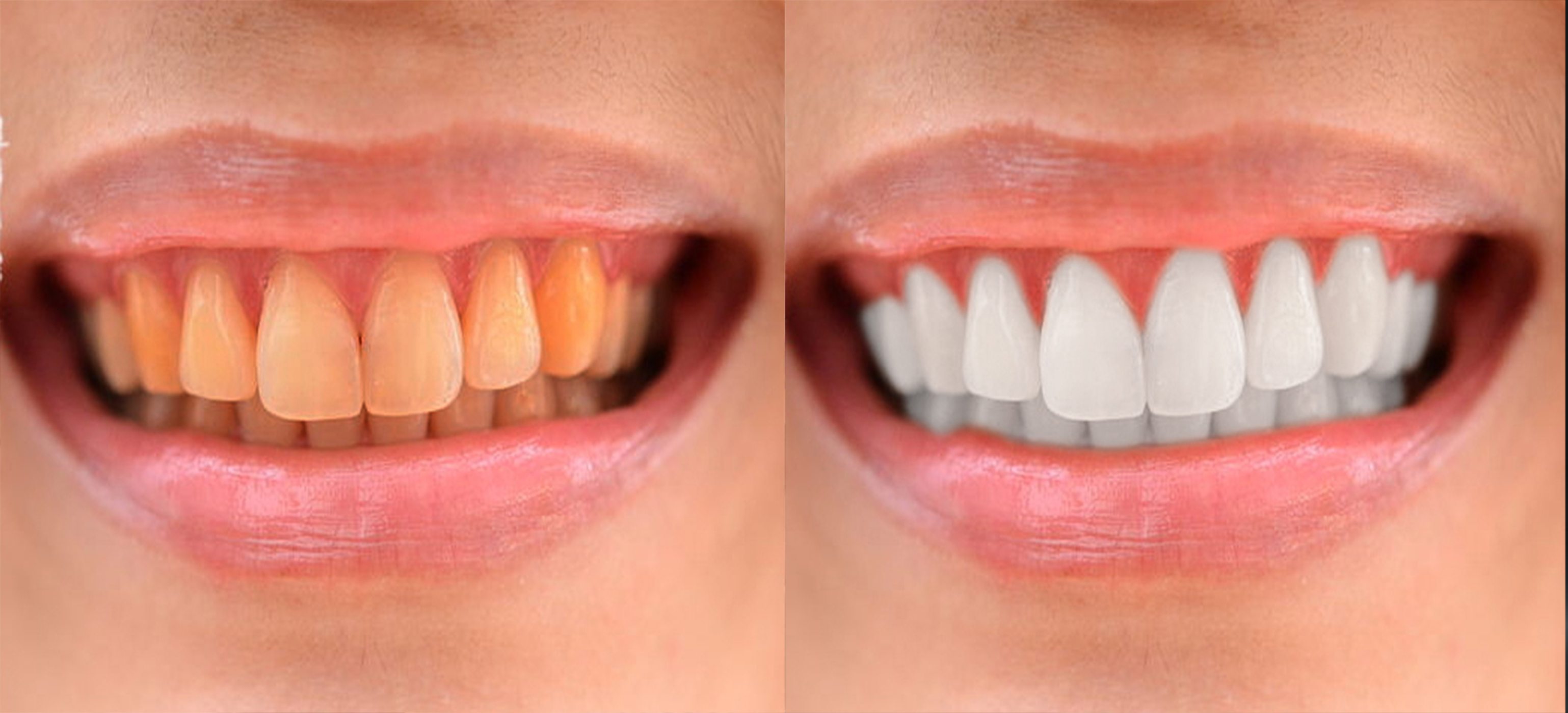 How To Whiten Teeth In Photoshop Welcome To Rephotosolution Background Removal Clipping Path 